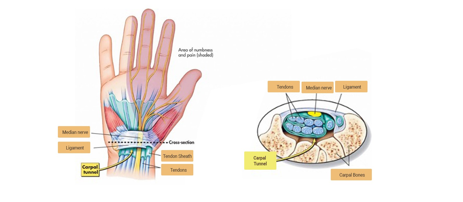 How an Early Case of Carpal Tunnel Syndrome, Could Have Prevented More Carpal  Tunnel Syndrome, but Ended Up Creating More… - Rocky Mountain Brain and  Spine Institute