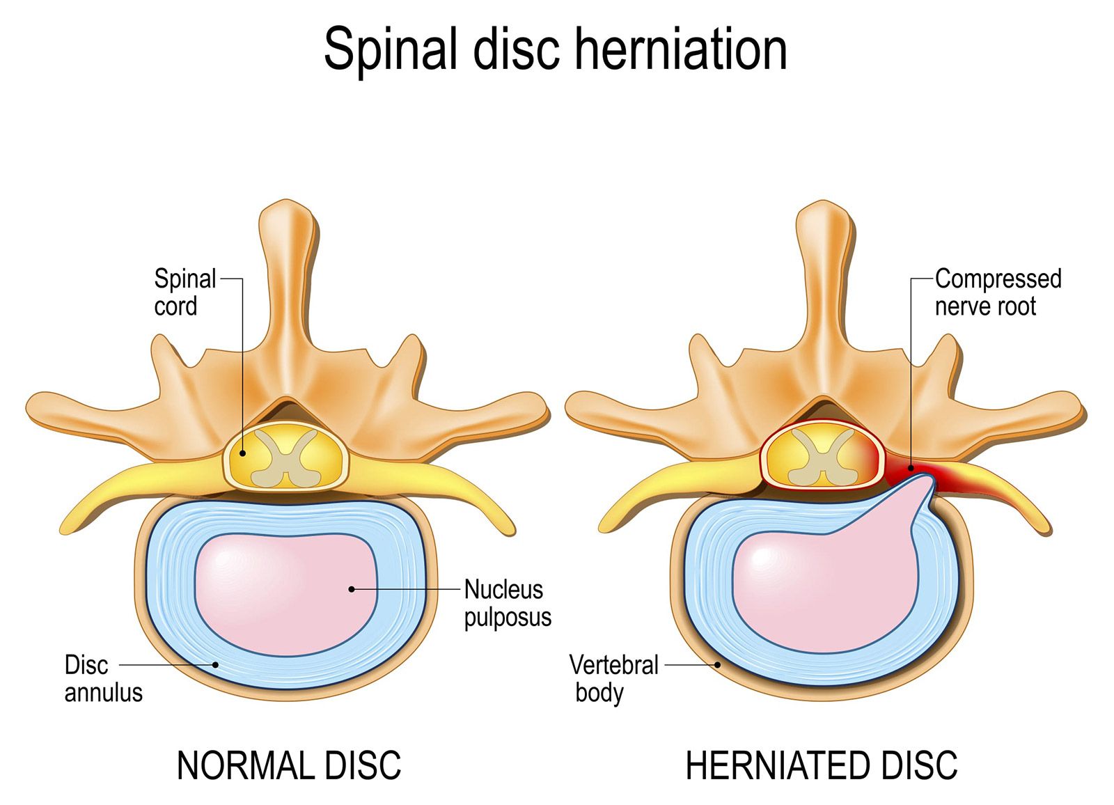 Chiropractic Care For Herniated Disc Dr Sima Goel